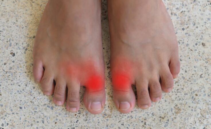 Pain in the big toes with gout. 